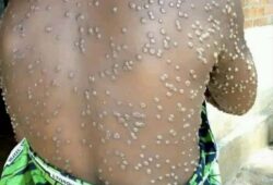 Kasaï Oriental : L&rsquo;épidémie de M-pox, un cas confirmé et 9 cas suspects signalés