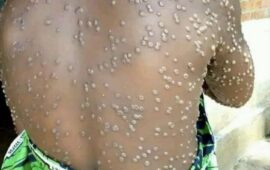Kasaï Oriental : L&rsquo;épidémie de M-pox, un cas confirmé et 9 cas suspects signalés