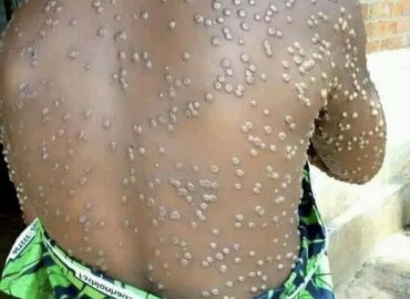 Kasaï Oriental : L&rsquo;épidémie de M-pox, un cas confirmé et 9 cas suspects signalés
